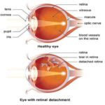 Retinal Detachment : Warning symptoms Patients Should Never Ignore