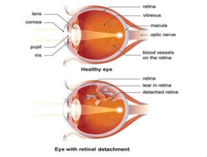 Read more about the article Retinal Detachment : Warning symptoms Patients Should Never Ignore