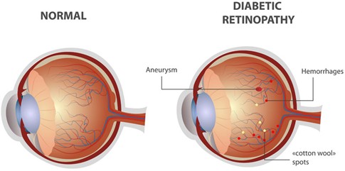Read more about the article Understanding Diabetic Retinopathy — Causes, Symptoms, and Stages:-