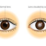 Cataracts and Diabetes: Understanding the Connection
