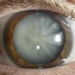 Understanding the World’s Leading Cause of Blindness