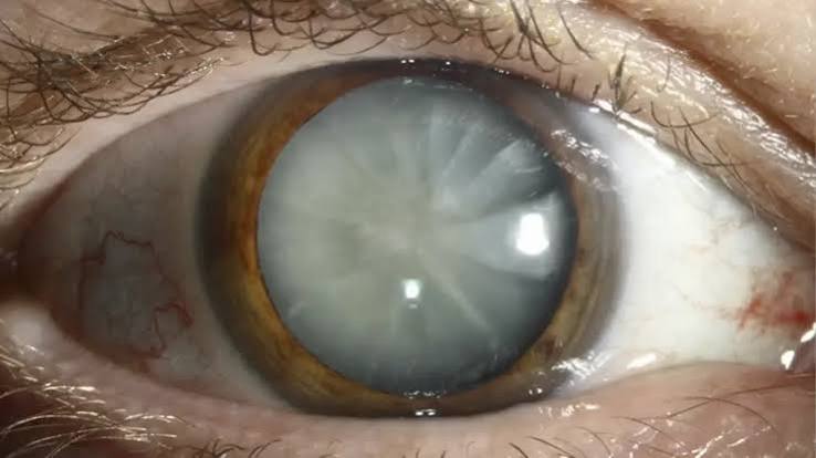 You are currently viewing Understanding the World’s Leading Cause of Blindness