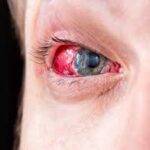 Firework Eye Injuries: Causes, Prevention, and Treatment