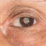 The Importance of Regular Eye Exams for Early Cataract Detection images (6)