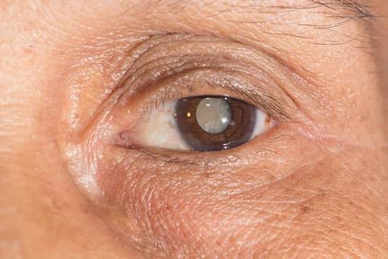 You are currently viewing The Importance of Regular Eye Exams for Early Cataract Detection