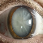 UV exposure and cataract Picture1