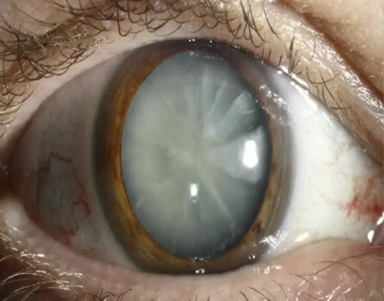 You are currently viewing UV exposure and cataract