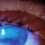 Photokeratitis