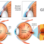 Glaucoma Risk in Women Picture2