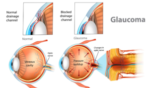 Read more about the article Glaucoma Risk in Women