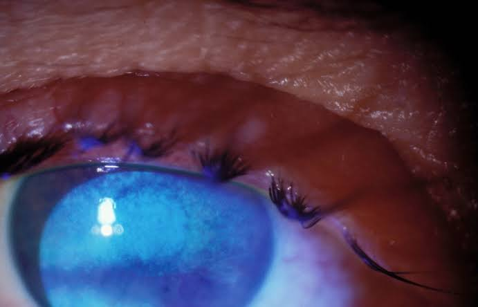 You are currently viewing Photokeratitis