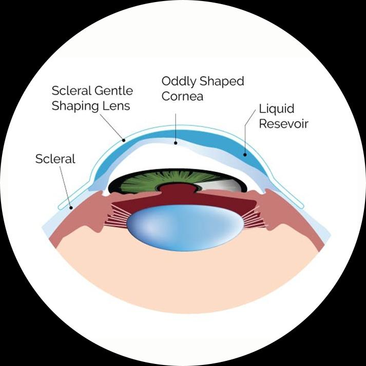You are currently viewing Scleral Lenses in Irregular Corneas