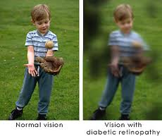 You are currently viewing Diabetic retinopathy: early detection and optometrist’s role
