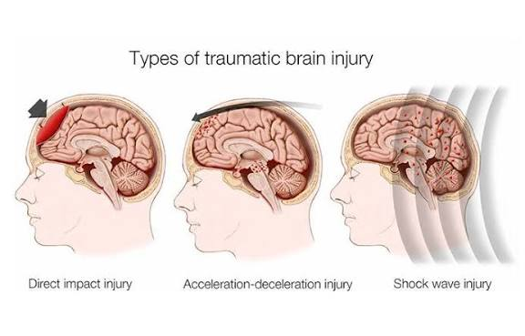 Read more about the article NEURO-OPTOMETRIC REHABILITATION AFTER TRAUMATIC BRAIN INJURY