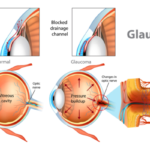 Glaucoma: The Silent Thief of Sight and the Importance of Early Detection Picture6