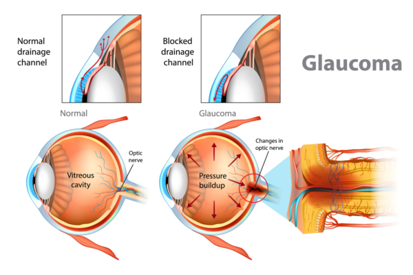 You are currently viewing Glaucoma: The Silent Thief of Sight and the Importance of Early Detection