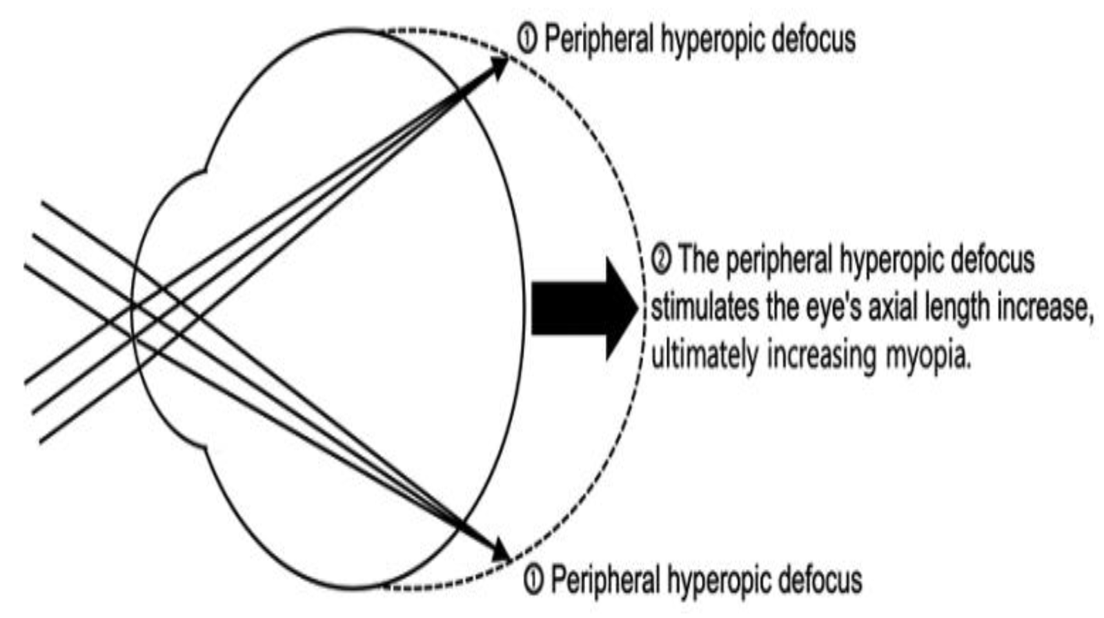 You are currently viewing Relative Myopic Defocus: Understanding the Theory