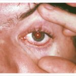 Trachoma img_diseases_12