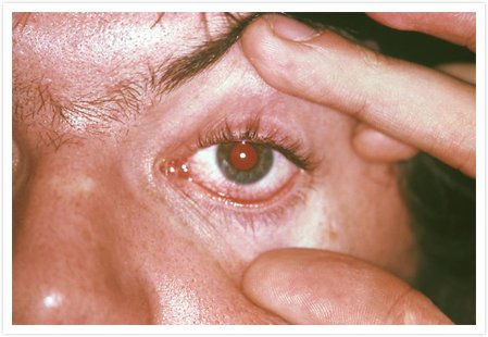 You are currently viewing Trachoma