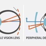 Seeing Beyond the Center: A Parent’s Guide to Peripheral Defocus and Myopia Control