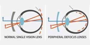 Read more about the article Seeing Beyond the Center: A Parent’s Guide to Peripheral Defocus and Myopia Control