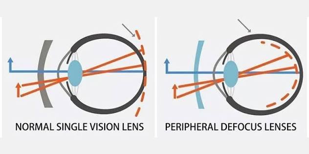 You are currently viewing Seeing Beyond the Center: A Parent’s Guide to Peripheral Defocus and Myopia Control